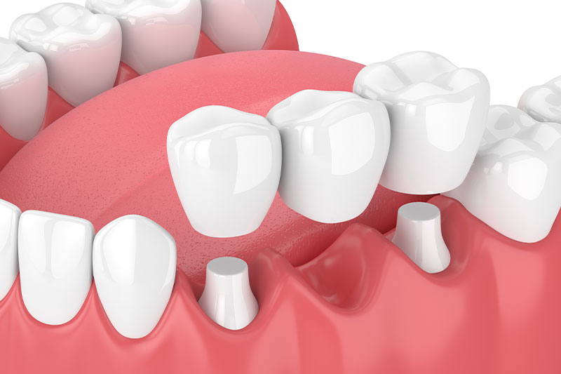 Dental Bridges in Dracut