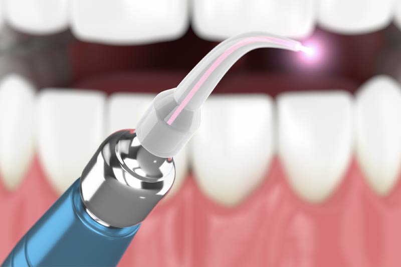 Laser Dentistry in Dracut
