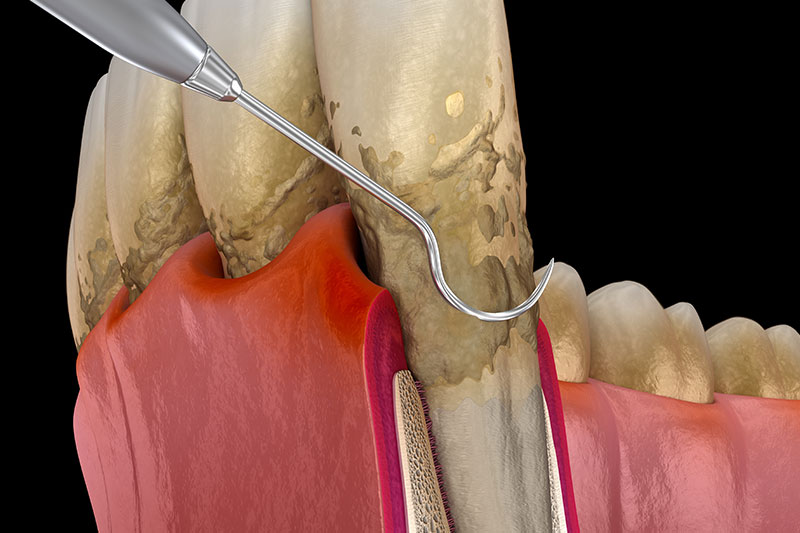 Periodontal Maintenance in Dracut
