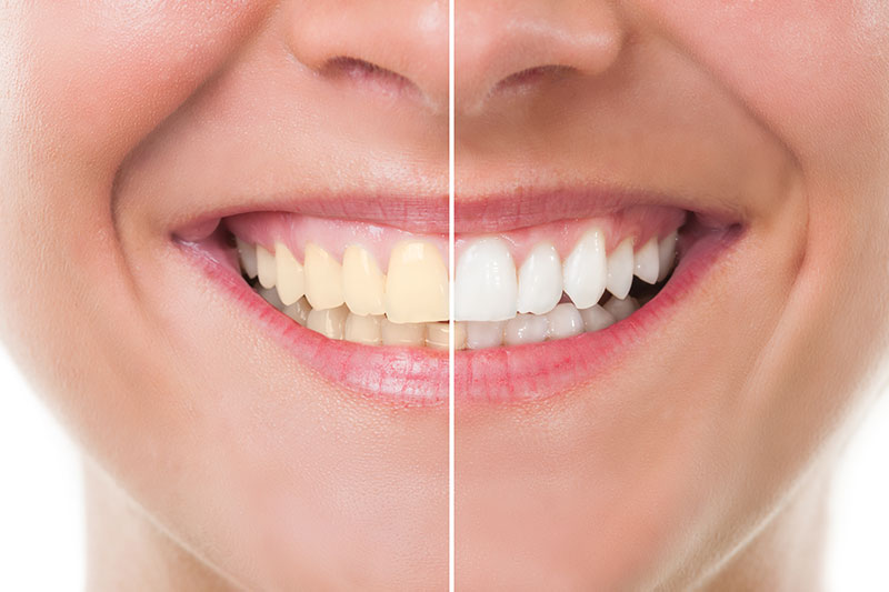 Teeth Whitening in Dracut